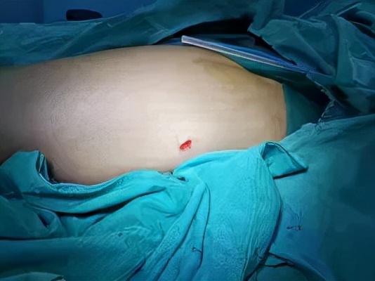 股骨头机器人手术微创,骨科机器人股骨颈手术