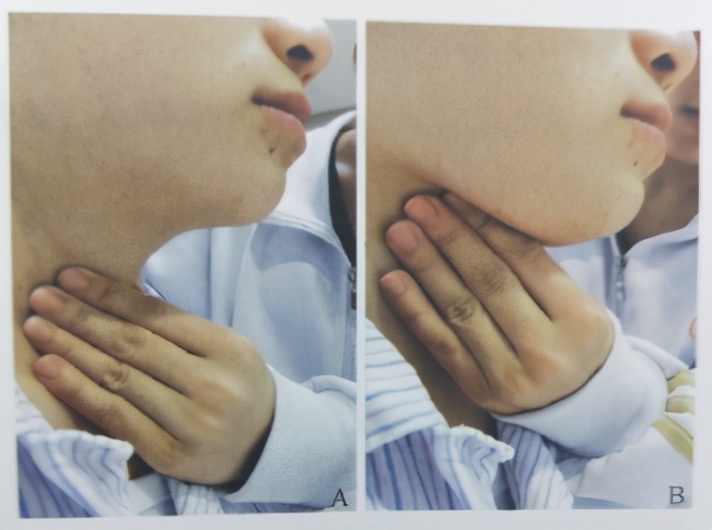 吞咽障碍的病因,吞咽障碍的康复训练儿童