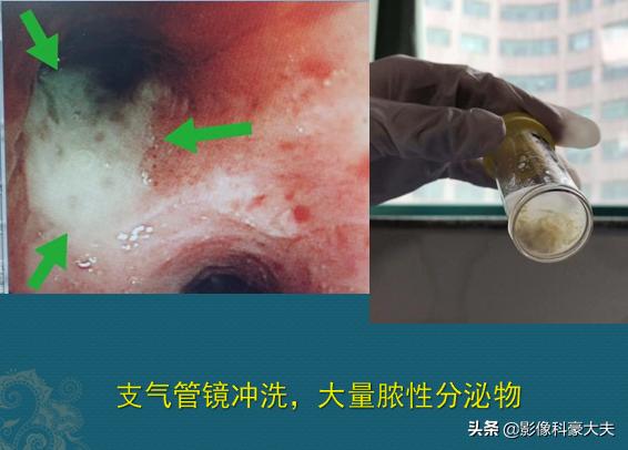 1场支原体肺炎，我拉黑了学理科的女同学