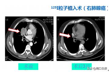 粒子植入治疗肿瘤和免疫疗法,肿瘤放射性粒子植入治疗技术