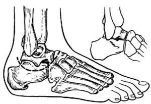 脚崴了踝骨骨折一直疼怎么办,踝关节崴了骨折有什么症状