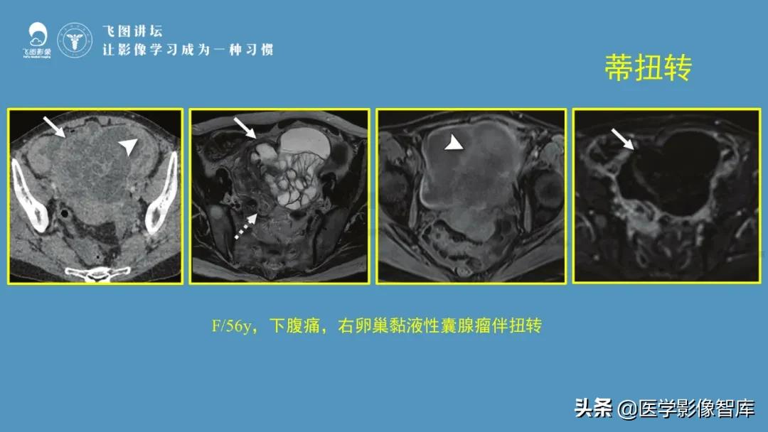 子宫解剖结构输卵管和卵巢位置,子宫附件ct影像学正常解剖表现