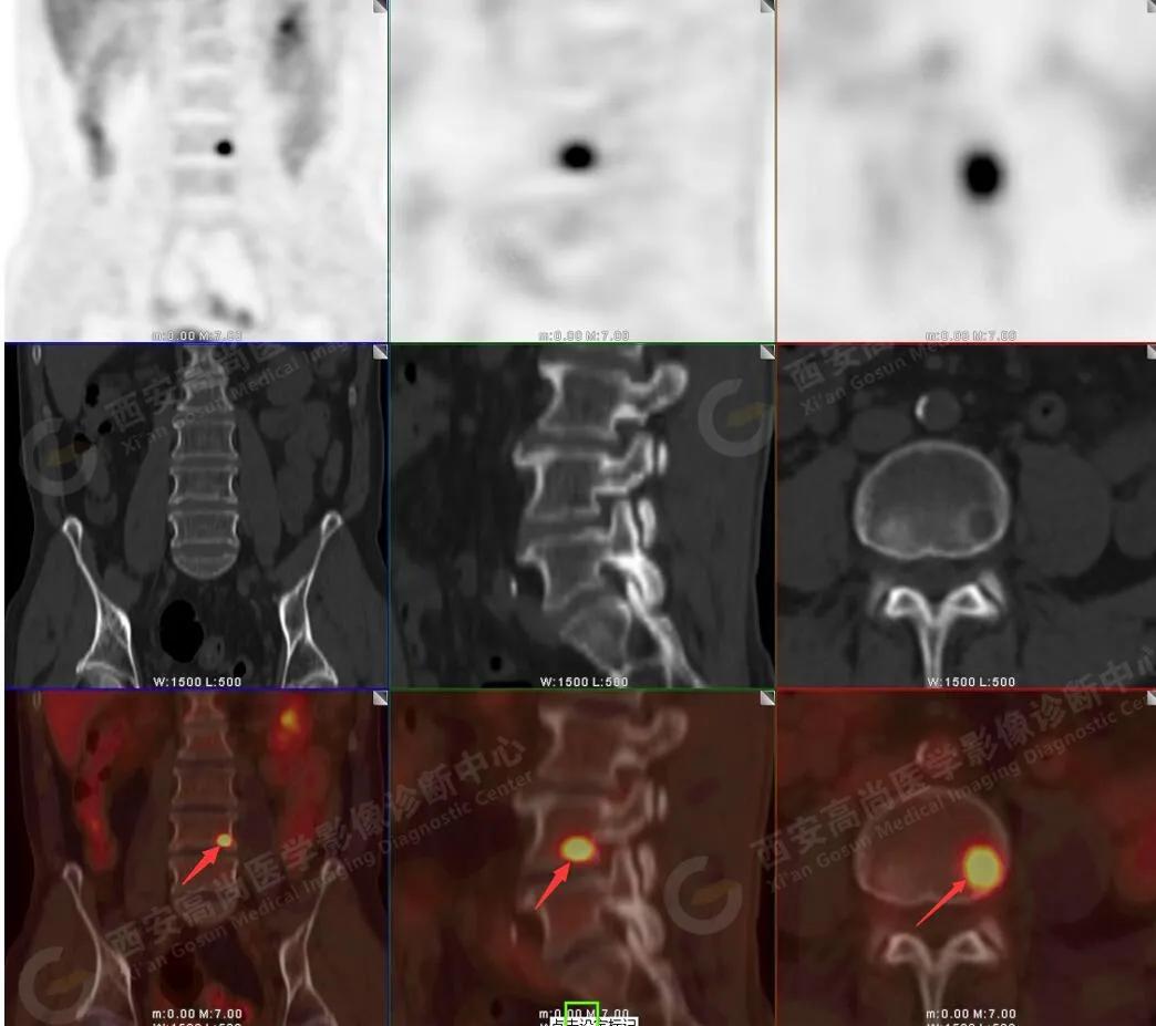 petct检查报告肺结节考虑恶性肿瘤,30mm肺结节pet显示没有转移