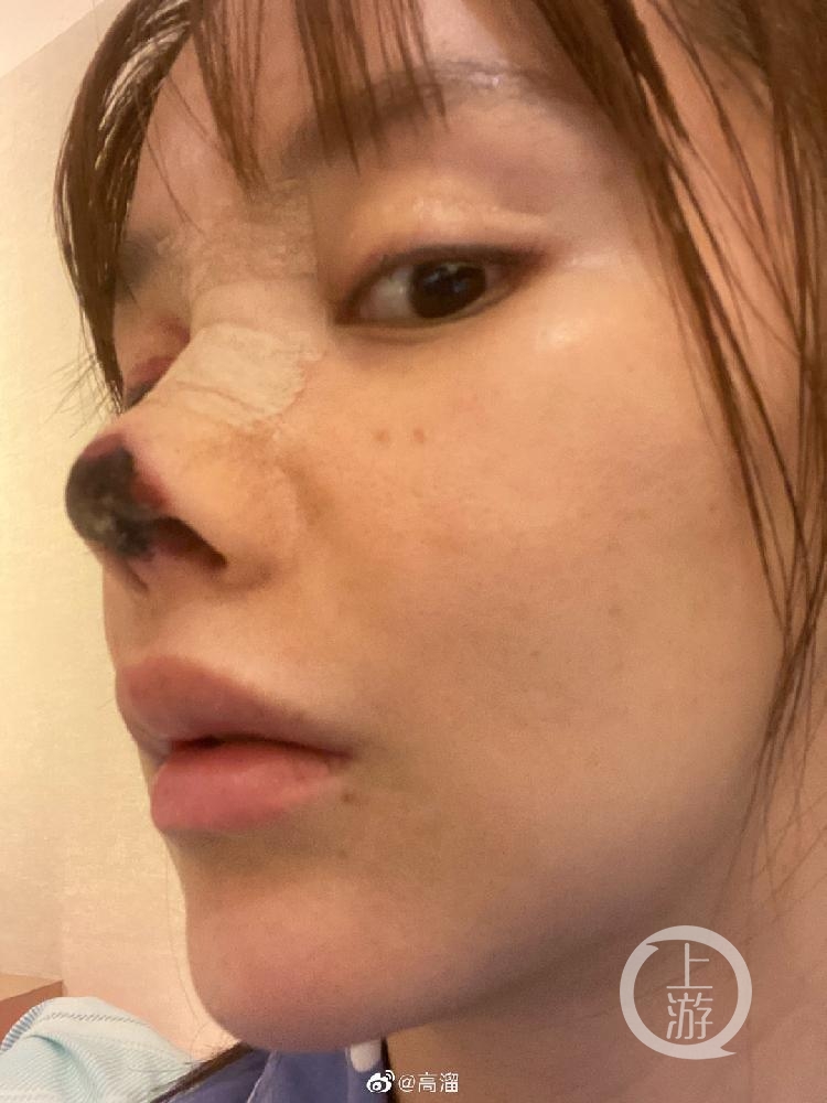 女星高溜自曝隆鼻失败鼻头坏死,女星高溜整形致鼻尖坏死