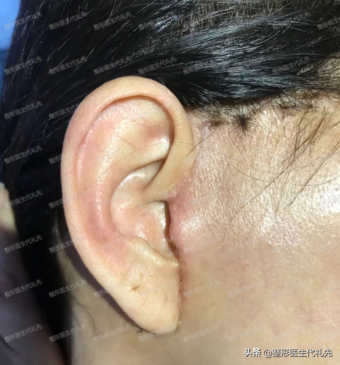 现在最流行的面部提升是什么项目,目前最先进效果最好的面部提升