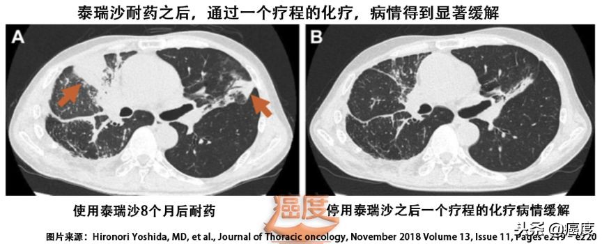 靶向药什么情况下可减量,靶向药泰瑞沙有治好的案例吗