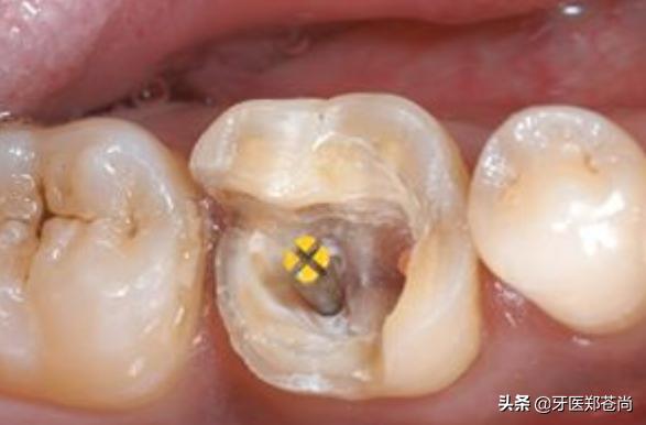 根管治疗又蛀牙了要重新治吗,蛀牙除了根管治疗还能怎么做