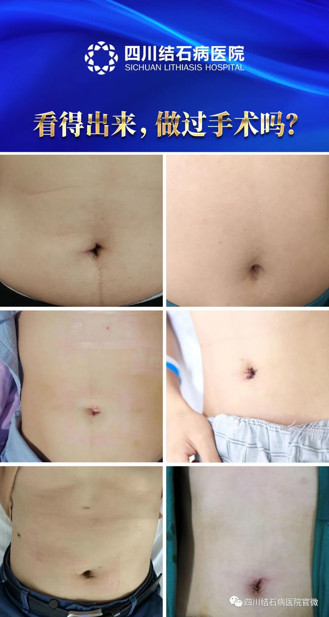 治胆结石是个小手术吗,胆结石是保胆好还是摘除好