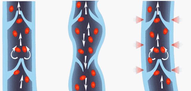 腿上有蚯蚓纹怎么回事,腿上出现蚯蚓似的纹路是怎么回事