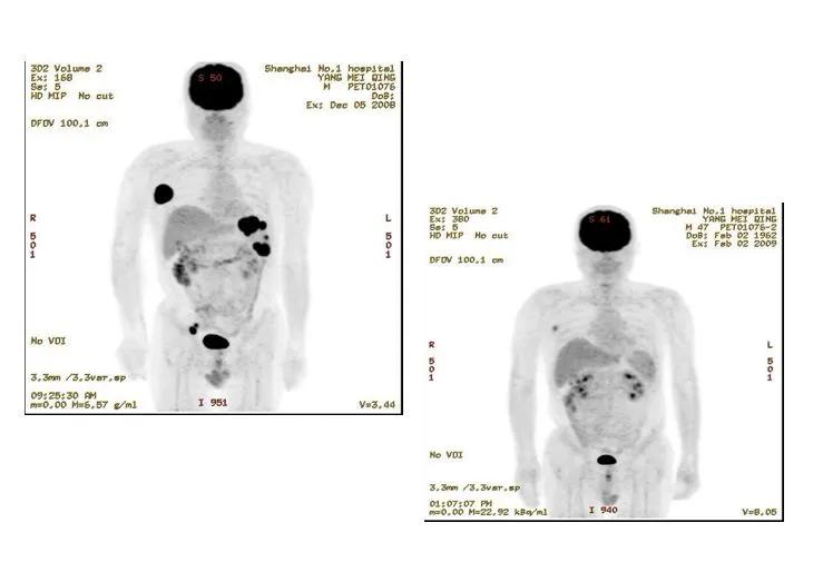 什么样的淋巴瘤要移植,淋巴瘤的移植方法