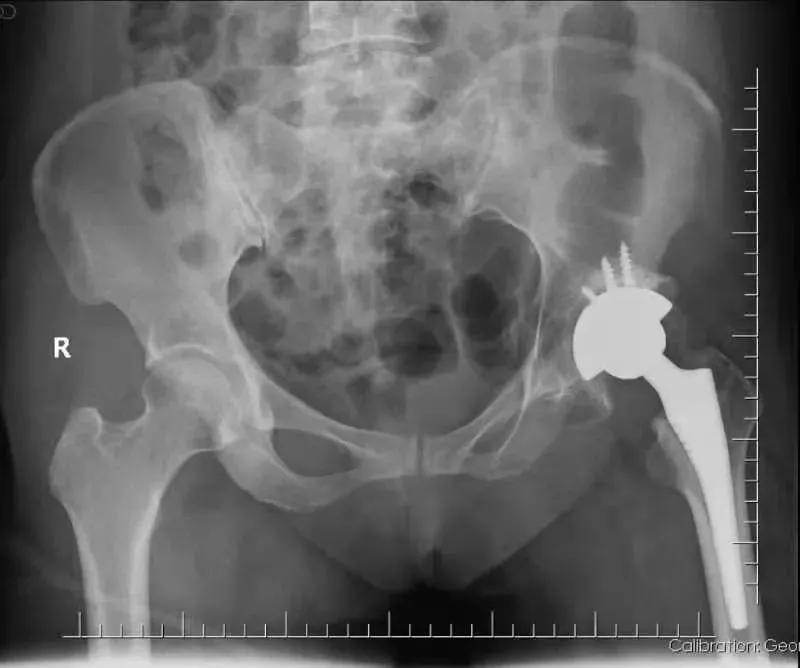 髋关节疼痛自愈的最佳方法,髋关节疼痛走路一瘸一拐