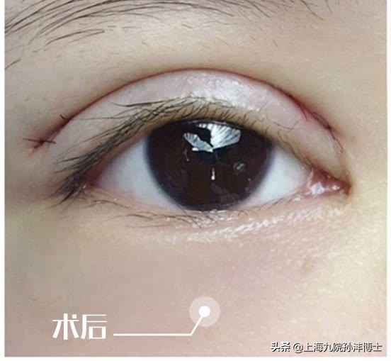 双眼皮修复眼角出现多层疤痕,医生推荐的双眼皮术后祛疤