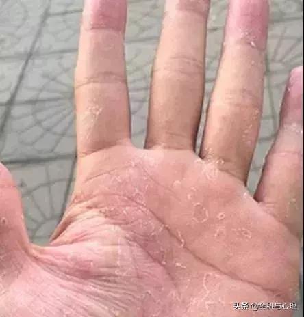 手臂腿上小水泡抓破很痒,手上脚上起小水泡很痒是怎么回事