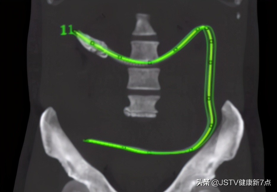 突发！长约40公分黄鳝从男子肛门钻进肚子