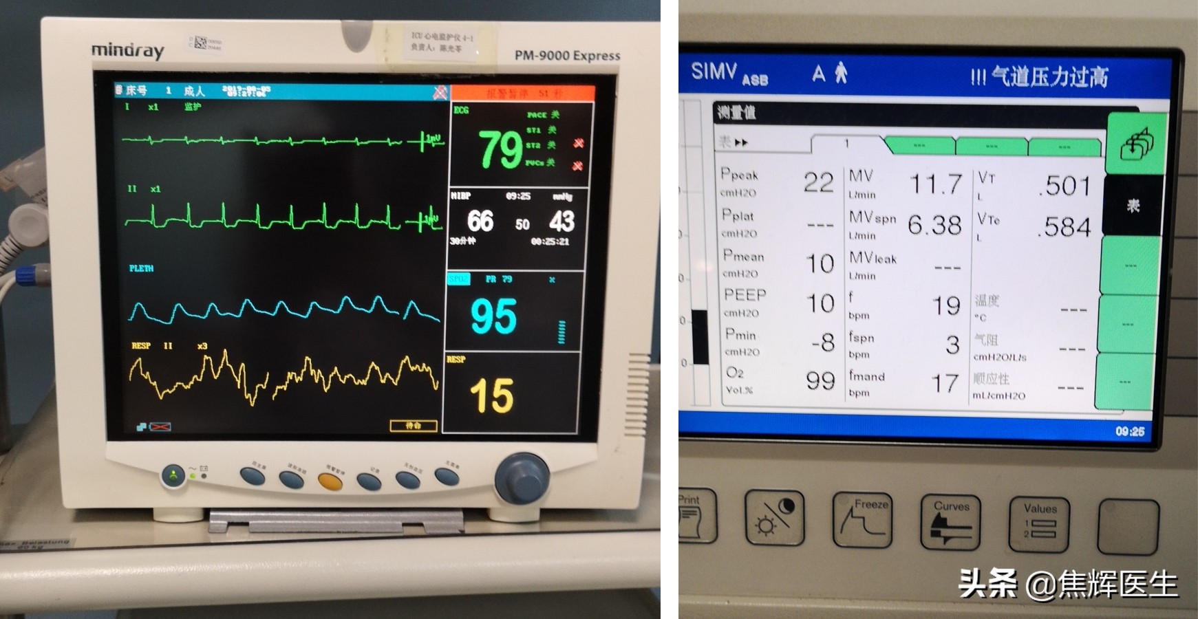 脑干出血最好的自己锻炼方法,怎么快速让脑干出血康复治愈