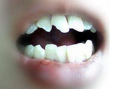 孩子牙痛要怎么解决,小朋友牙痛的原因有哪些呢