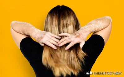 治疗白癜风是真的吗,治疗白癜风的药为什么都伤肝