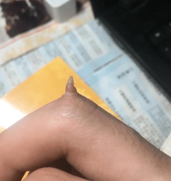 中指关节处有死肉,中指长了一个肉球