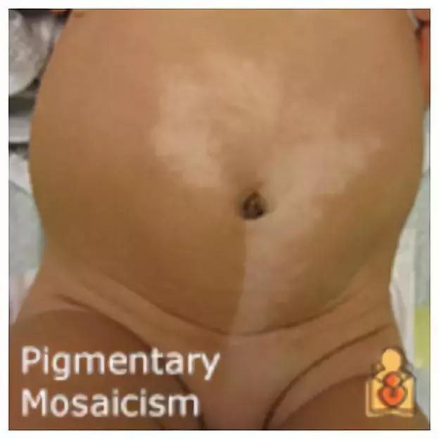 为什么宝宝出生屁股会有青胎记,宝宝出生屁股上有淤青是什么原因