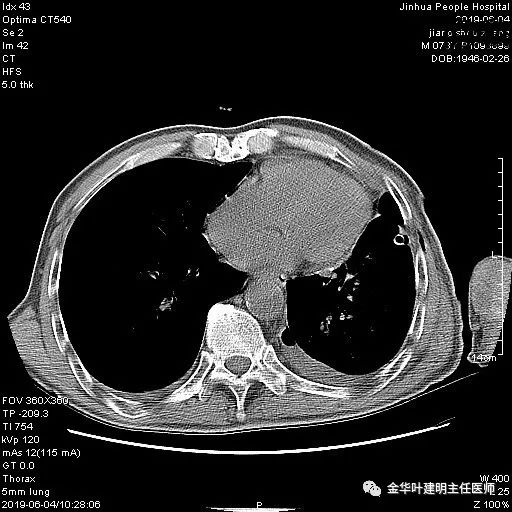 手术引起乳糜胸,有没有做了肺结节手术后是误诊的