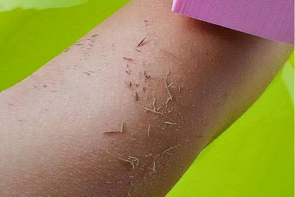 如何有效的去角质,去角质方法长期不去角质会怎样