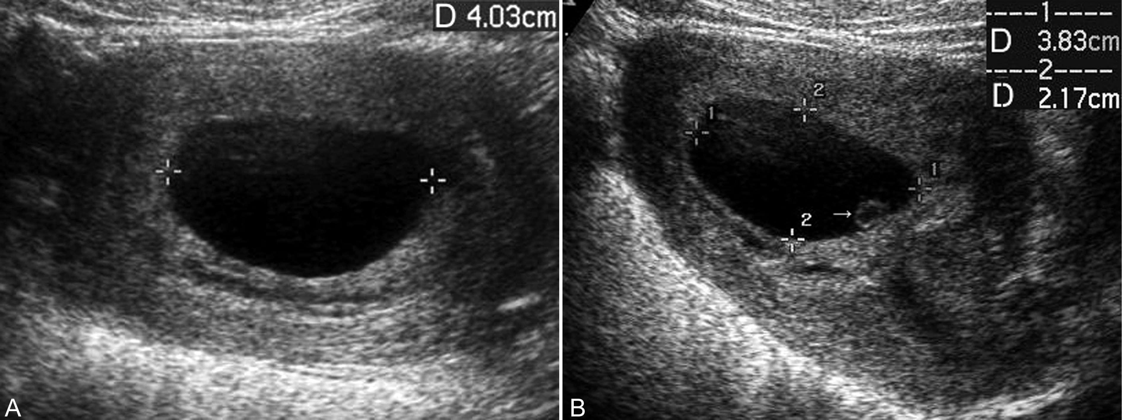 经阴超声检查可以看出来流产吗,流产残留超声诊断