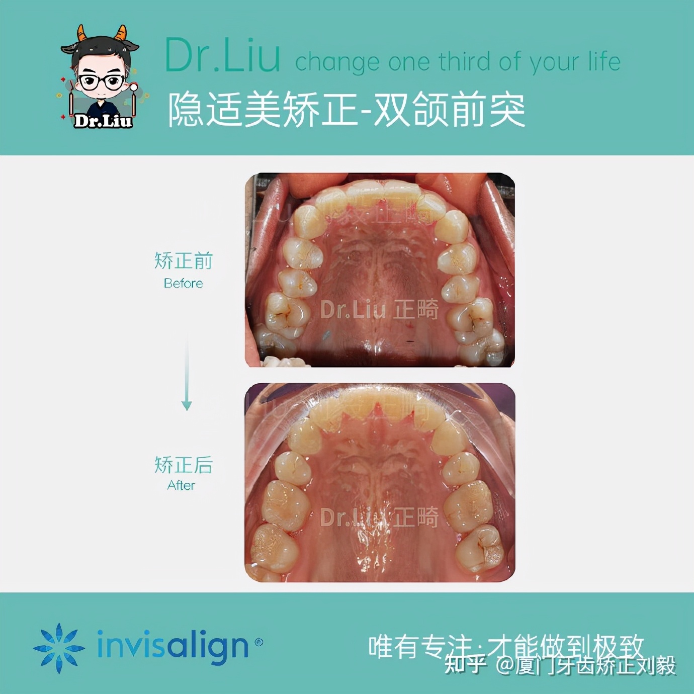 厦门成年人牙齿舌侧矫正,下嘴唇厚且外翻牙齿矫正