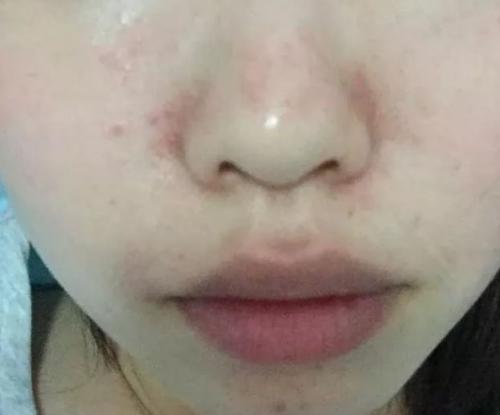 脸部红血丝严重咋办,脸部皮肤带血丝怎么去掉