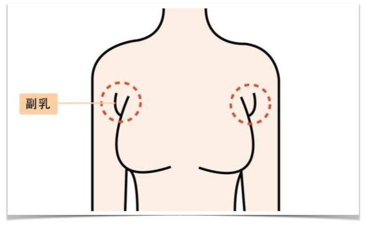 穿吊带有副乳快速处理,穿衣服有副乳怎么遮盖副乳