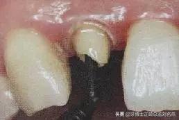 纤维桩修复费用,纤维桩修复全过程视频