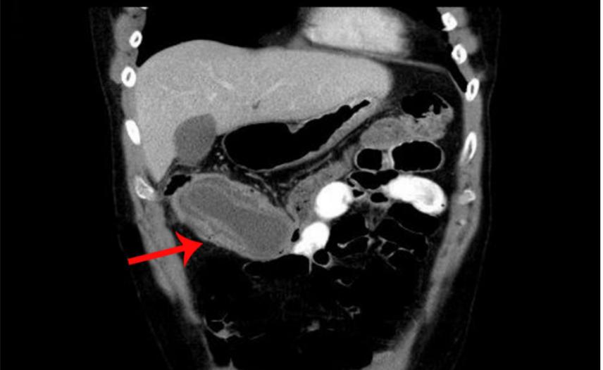 便血可触及腹部包块,肠套叠肚子轻微疼痛