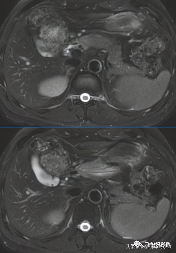 「飞利浦磁共振技术」胆道系统胆胰管水成像之3D_MRCP_BH