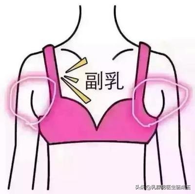 女性乳腺发育症长什么样,多乳症的人位置都一样吗