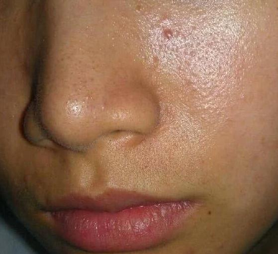 毛孔粗大应该涂什么可以隐藏,毛孔粗大要去除角栓吗