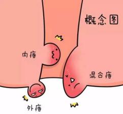 内痔疮便血脱肛怎么治疗好,痔疮便血怎么治疗最好