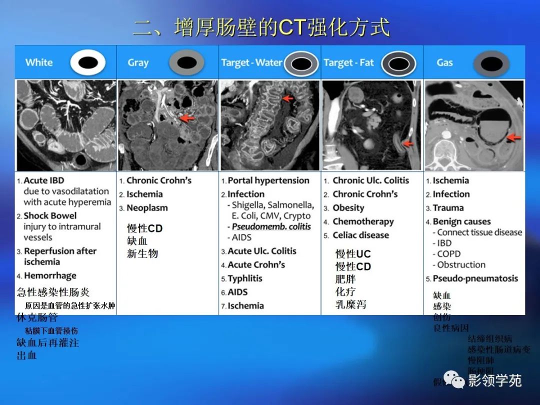 肠道内壁增厚,肠道扩张ct表现