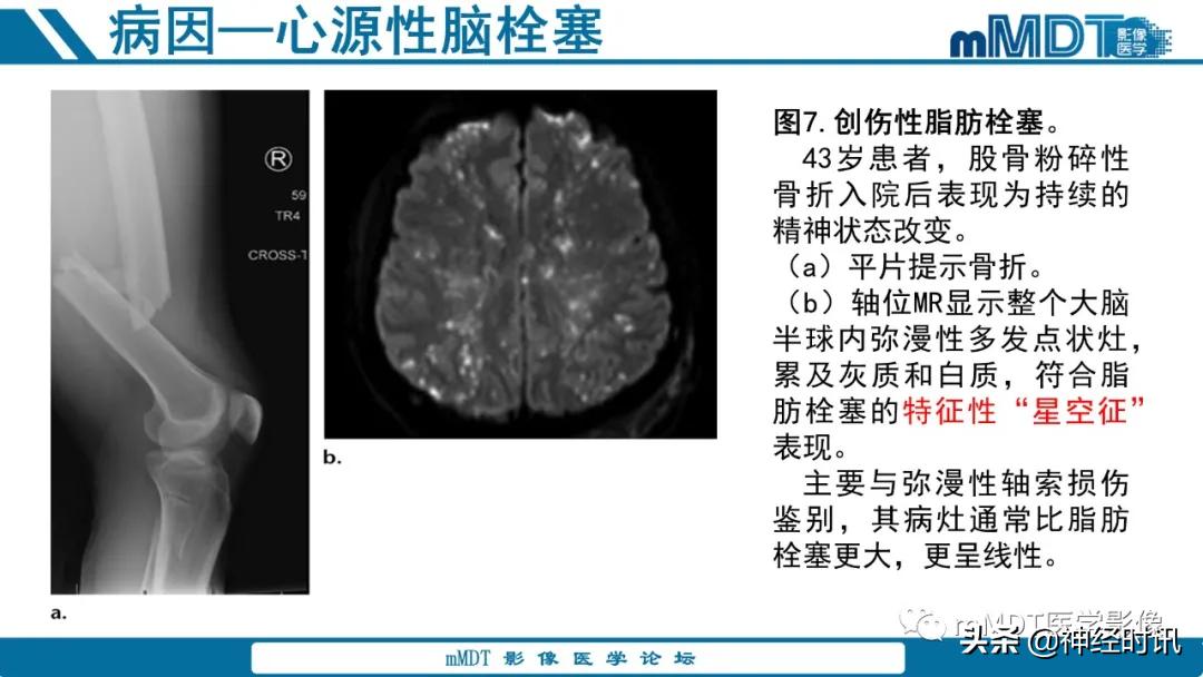 缺血性脑卒中护理课件,缺血性脑卒中讲课ppt