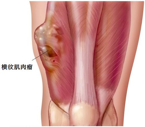 恶性肿瘤不是慢性病吗,癌就是恶性肉瘤吗