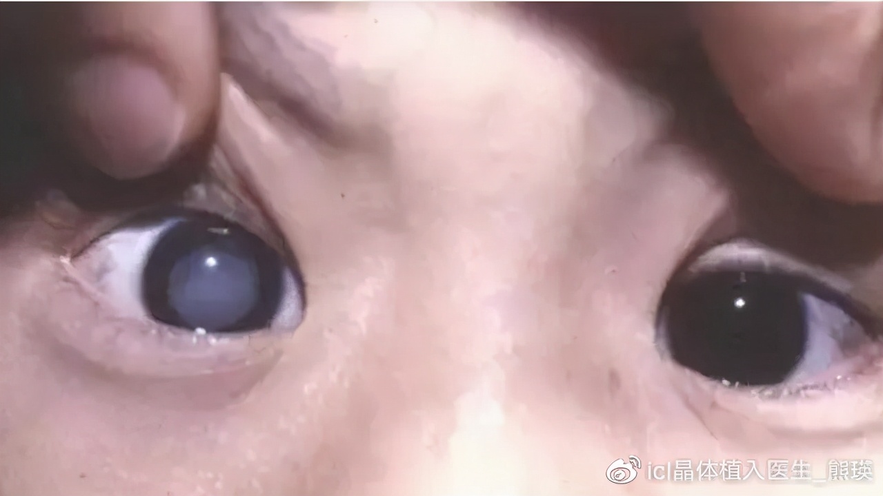 小孩6岁有远视需要治疗吗,儿童眼病的种类和表现症状