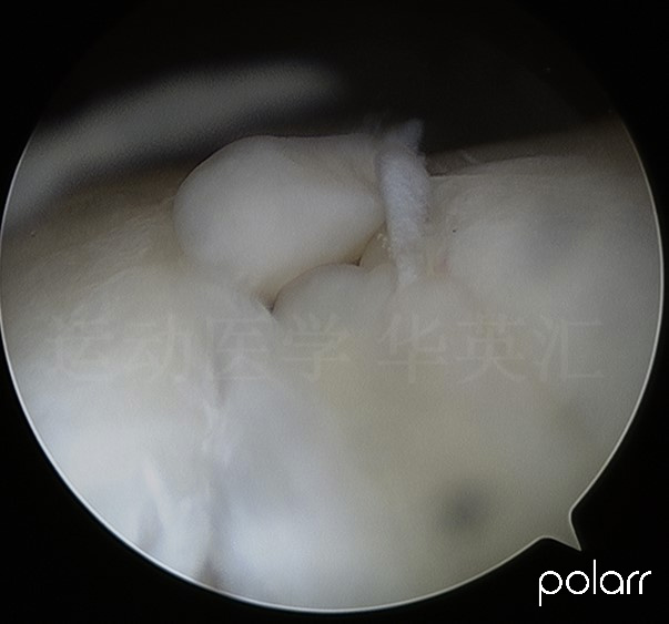 前交叉韧带断裂十年还需要治吗,前交叉韧带1°损伤能自愈吗