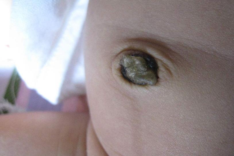 新生儿脐带护理正确的方法,新生儿脐带护理有哪些注意事项