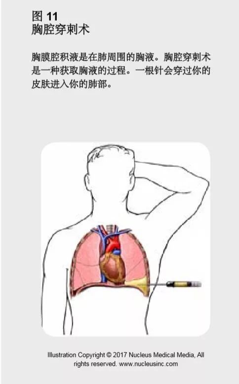 肺癌诊疗指南2023在哪可以查阅,2019肺癌诊疗指南pdf