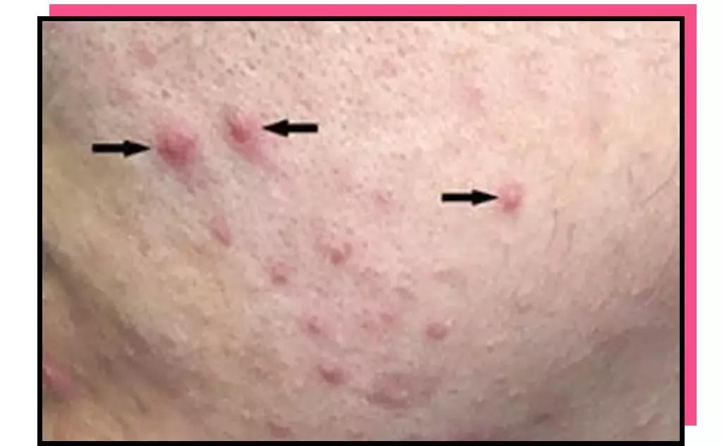 痘肌调理真实案例,痘肌10年了怎么修复