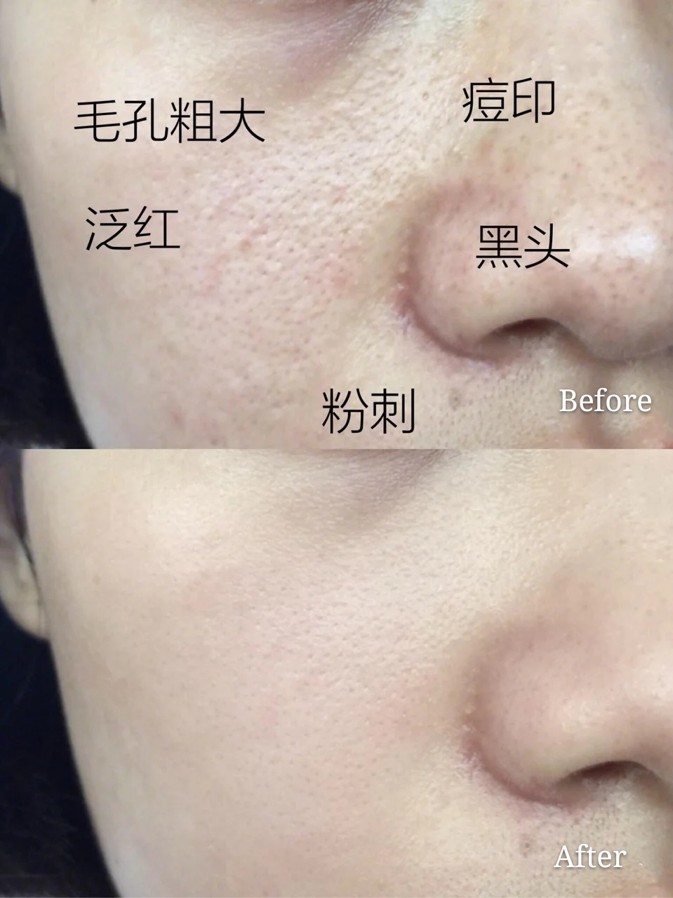 美容针美容的误区,为美而整容最后付出的代价