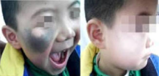 为什么刚出生的婴儿屁股上有青迹,为什么婴儿出生屁股会淤青