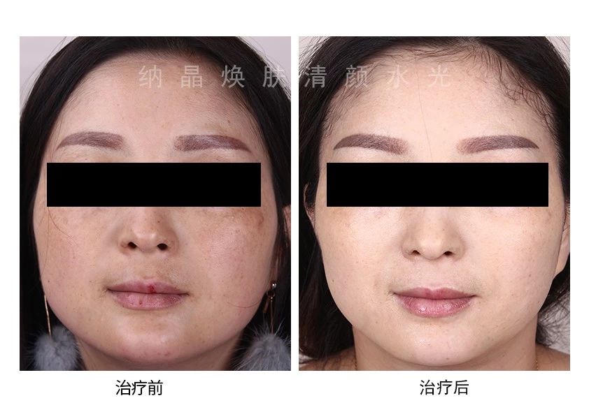 褐青色斑选择什么方法祛好点,身上淡褐斑变成深褐斑