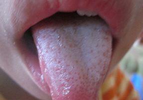 宝宝舌苔怎么辨别热还是寒,如何看宝宝舌苔来区别是否感冒