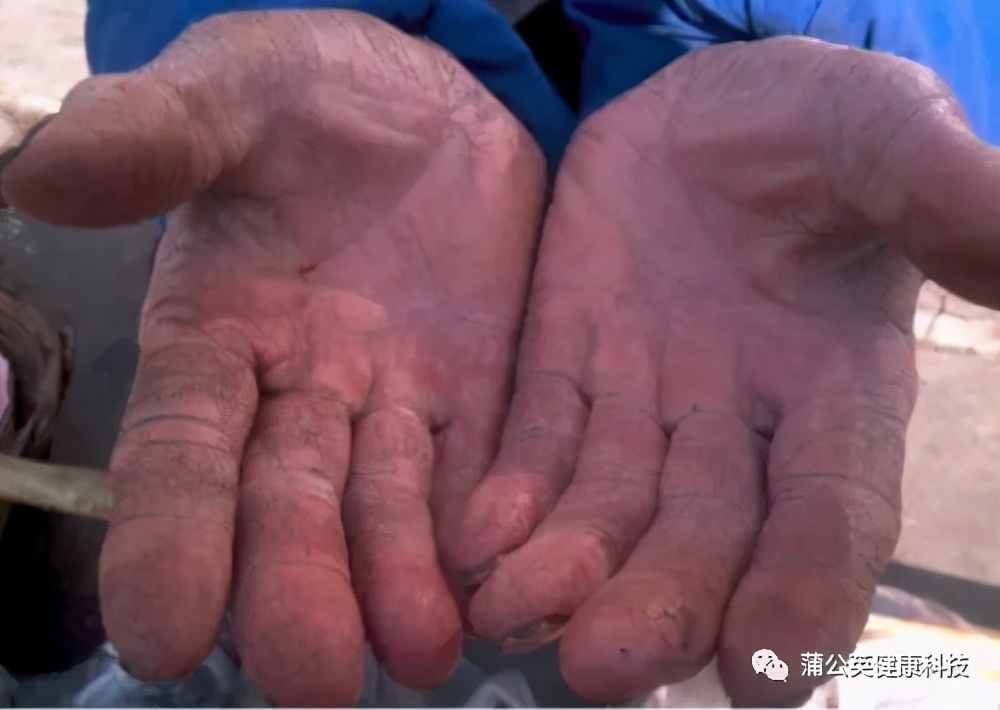 手脚癣痒烂怎么治疗,手脚癣用什么药水泡才能治好