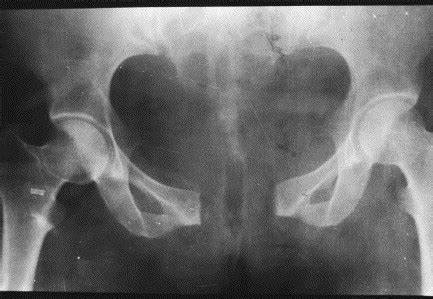 产前耻骨痛产后什么时候能恢复,产后20天突然耻骨痛是缺钙吗