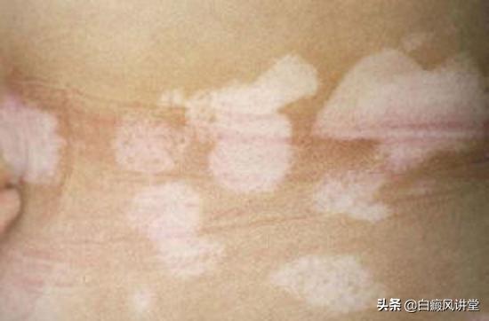 308准分子激光治白癜风几次见效,308nm准分子治疗白癜风的价格